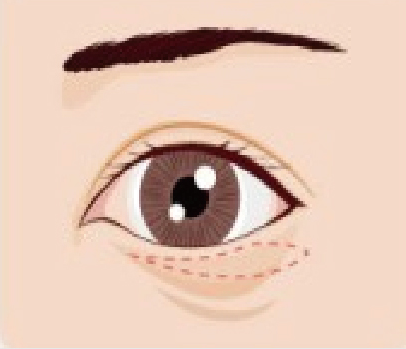 하안검수술01
