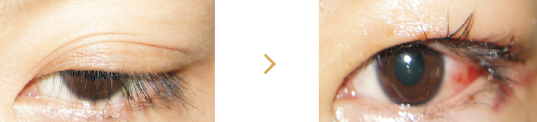 안검하수의 치료01